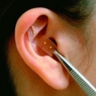 Curso de Auriculoterapia